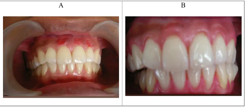 Gambar 5. Penutupan daerah operasi dengan pembalut periodontal