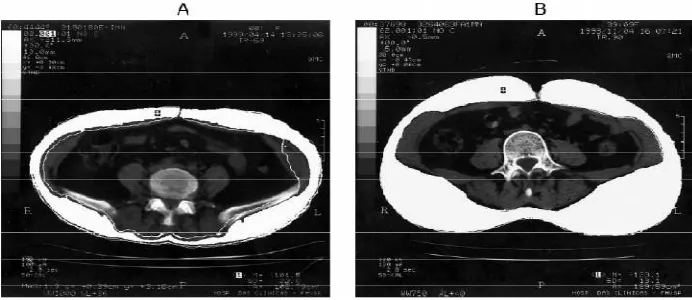 Gambar 2.1: Dengan menggunakan computed tomography dapat dibedakan antara A. visceral adipose tissue (VAT) dan B