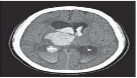 Gambar 2. Perdarahan intraventrikular pada Head CT scan 