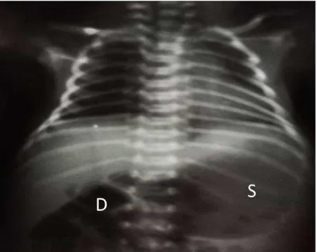 Figure 1.  Plain X-ray of the abdomen shows distended (D). Presence of bowel gas distal to the proximal duodenum is stomach(S) and passage of gas in the proximal duodenum hardly portrayed in this photo