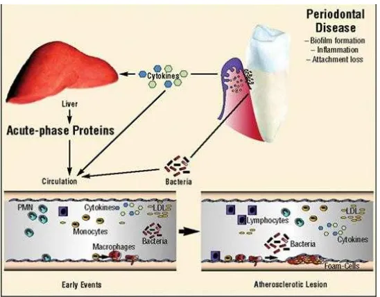 Gambar 2. Hubungan penyakit periodontal dengan aterosklerosis (Dave, et     al. 2004)  