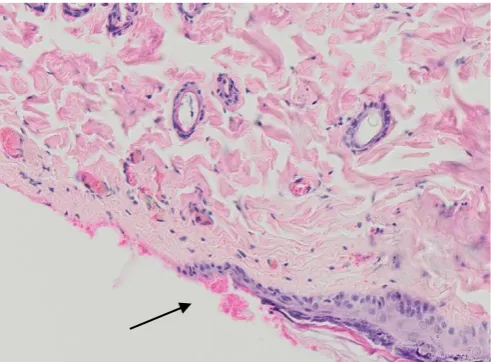 Gambar 2 Histopatologi Luka Antemortal, 4 Jam Setelah Perlukaan (Pembesaran 200x)     Ket.: tanda panah menunjukkan akumulasi sel-sel radang netrofil 