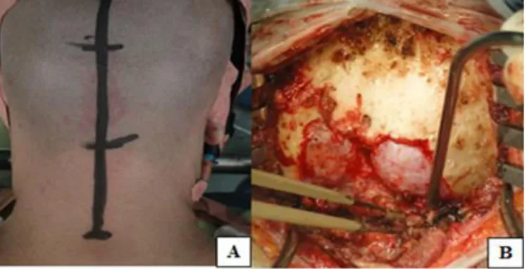 Fig 2. A) Linear Skin Incision  B) Foramen Magnum Decompression and C1 Laminectomy 