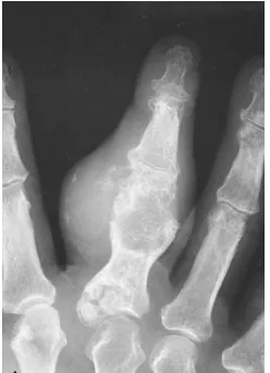 Gambar 13 Chondrosarcoma  Primer Sentral pada Tangan.8 