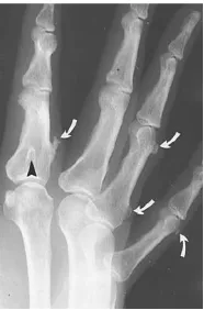 Gambar 14 Multiple Osteochondroma pada Tangan 