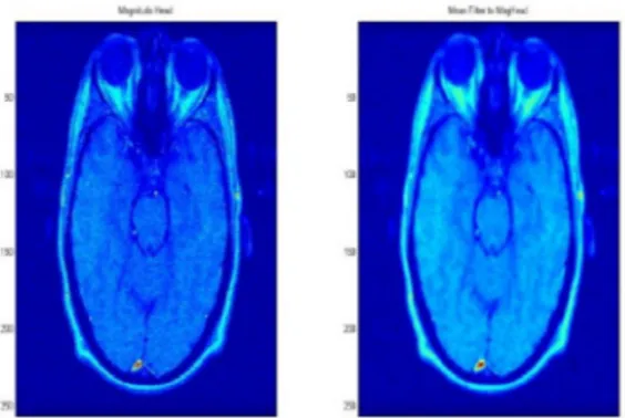 Gambar 15.a. Citra MRI dan  Penapisan Mean. 