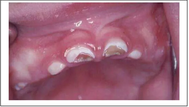 Gambar 1. Karies gigi pada anak-anak.17  