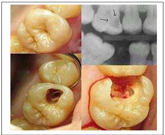 Gambar 3. Karies pada proksimal gigi yang berlanjut hingga karies  yang melibatkan pulpa.8 