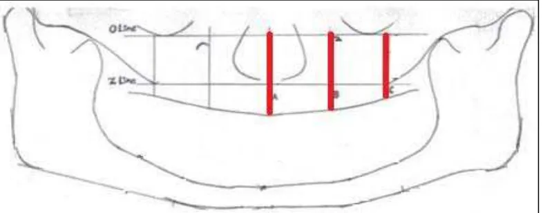 Gambar 5.  Pengukuran   ketinggian  maxillary  alveolar  ridge pada sampel bergigi.                    Garis O-garis infraorbital; garis Z–garis zigomatik; garis A, B, C-garis O                    ke alveolar  crest  (1,2 mm dari  cementoenamel  junction) pada midline                    rahang  atau   titik  tengah  kedua  insisif  sentral (A), distal premolar                     pertama (B) dan distal molar pertama (C)8 