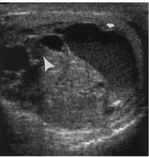 Gambar 2.1. Seminoma  pada seorang laki-laki usia 35 tahun. Ultrasonografi testis 