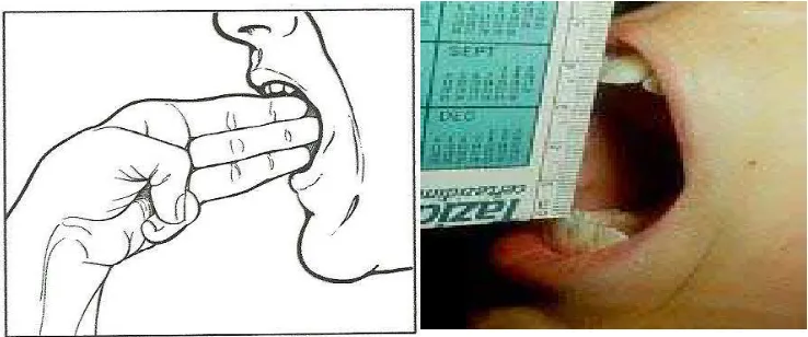 Gambar 7. Pembukaan  mulut normal (http://www.srtpsc.com/7case00.html)  (4 november  