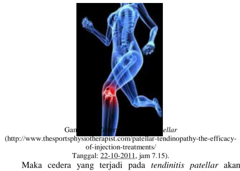 Gambar 2: Cedera Tendinitis Patellar 