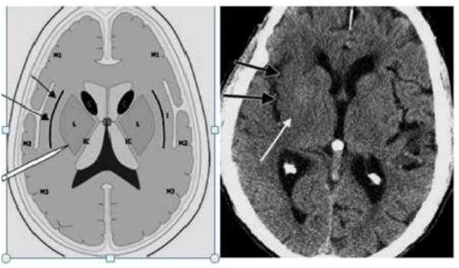 Gambar 1 : Skematik potongan aksial dari CT imaging. Daerah yang di perdarahi MCA (kiri), gambaran CT imaging dari wanita berusia 78 tahun 