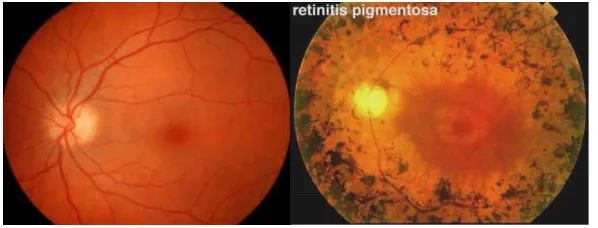 Figure 3. Fundus  appearance  of  normal  eye  and  RP 