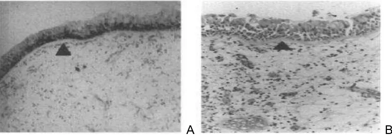 Gambar 2.1 A. Edematous, Eosinophilic Polyp. Terdapat banyak sel-sel inflamasi, paling banyak adalah eosinofil dan sel mast