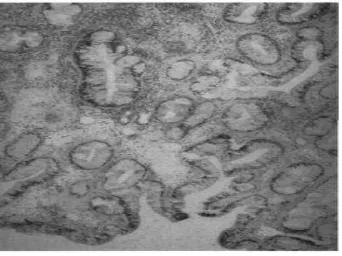 Gambar 2.3 Polip hidung dengan hiperplasia kelenjar seromusin. Namun tidak terdapat atipia (Hellquist, 1996)