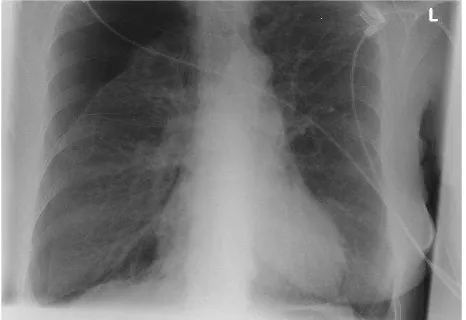 Figure 1. Right apical secondary spontaneous pneumothorax
