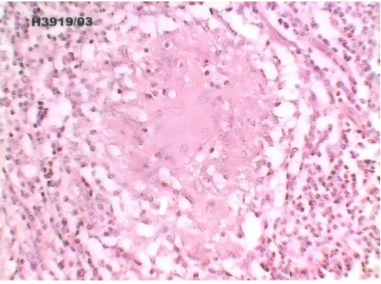 Figure 1. Microphotograph showing Well Differentiated Adenocarcinoma with pool of mucin (H&E, X 40) 