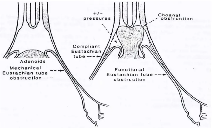 Gambar 4. Mekanisme adenoid obstruktif. 3 