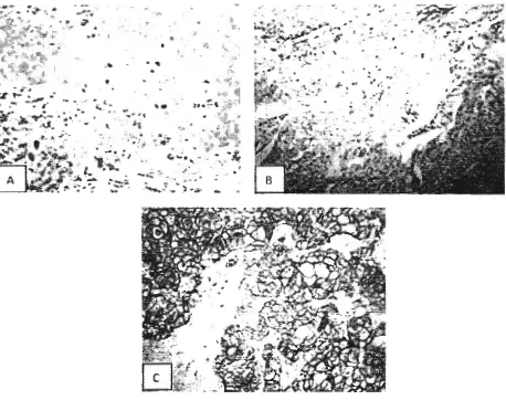 Gambar l.Tampilan Her-2 pada karsinoma duktus invasif(A) Terpulas lemah yang memberikan 