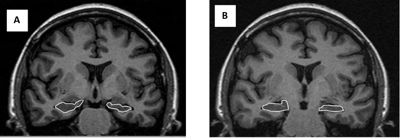 Gambar 1.Potongan koronal MRI (A) Hippokampus bilateral normal. (B) 