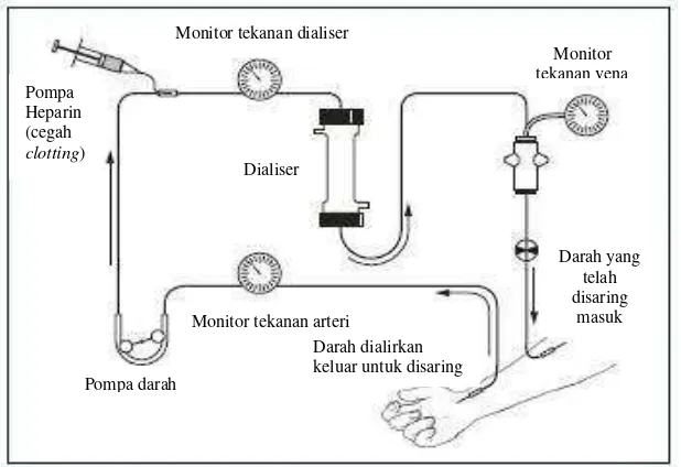 Gambar 1. Proses hemodialisis dalam Treatment methods for kidney 