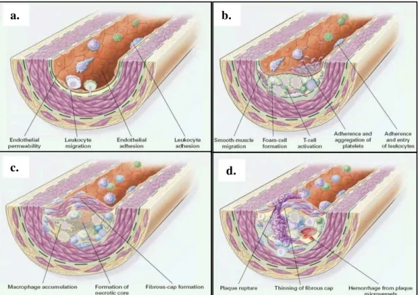 Gambar 1.  Tahapan terbentuknya aterosklerosis; a. Disfungsi endotel; adhesi dan  migrasi    lekosit  ke    dalam  dinding  arteri;  b