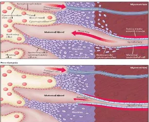 Gambar 2. Perbedaan arteri spiralis pada kehamilan normal dan PE(3)
