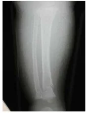 Figure 1.  Metaphyseal fracture at distal and proximal tibia 