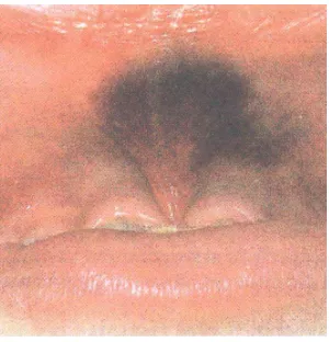 Gambar 1. Memar pada frenulum labialis yang terjadi karena pukulan pada wajah.2  