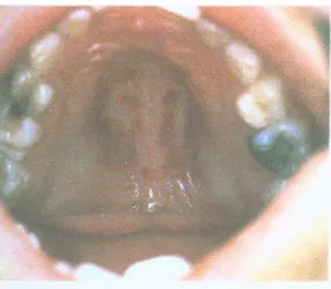 Gambar 3. Tanda bekas gigitan pada anak usia 18 bulan A dan 3 bulan B.2  