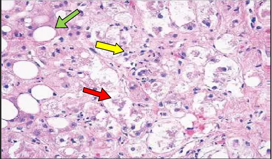 Figure 1. Histopathological features in a liver-biopsy specimen in AH. Adapted from : - Michael R