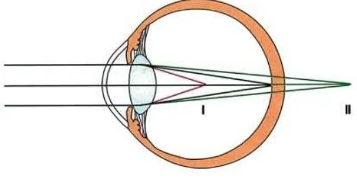 Figure 2. Myopic refractive errorI is the focus point of myopic eye. II is the focus point of hyperopic eye
