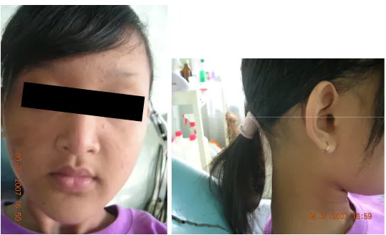 Gambar 1. Profil pasien. Gambar kanan menunjukkan rambut yang jarang dan tipis 