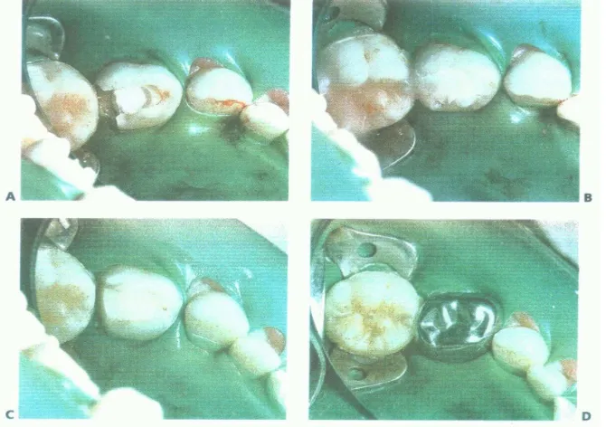 Gambar 1. A Gigi setelah pulpotomi. B. Sebelum preparasi untuk SSC, gigi dibentuk kembali dengan GIC