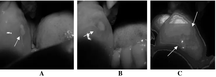 Figure 3. Scale 3 mucositis in the tongue border. 2 days after initial administration of intrathecal dose methotrexate (A)