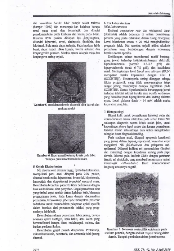 Gambar 6. Erosi maspif tertutup krusta pada bibir.