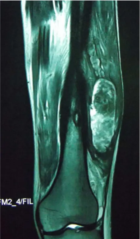 Figure 4. Post-treatment MRI of the thigh showing only sclerosis of the bone with no residual mass