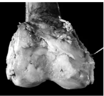 Gambar 2.2  Gambaran Radiologik Osteoartritis Lutut9 