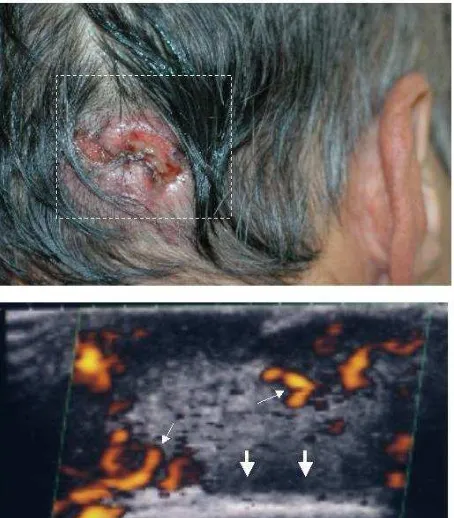 Figure 1. Image from case 1: Basal cell carcinoma. An ulcerated skin lesion was found in occipital region (upper)