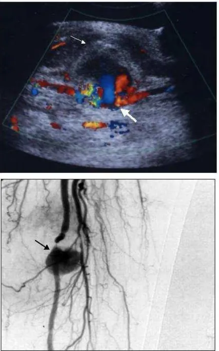 Figure 3. Images from case 3: Arterial pseudoaneurysm. Ultrasound 