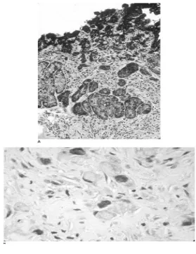 Gambar 2.6 Histopatologi Adenocarcinoma Gaster 