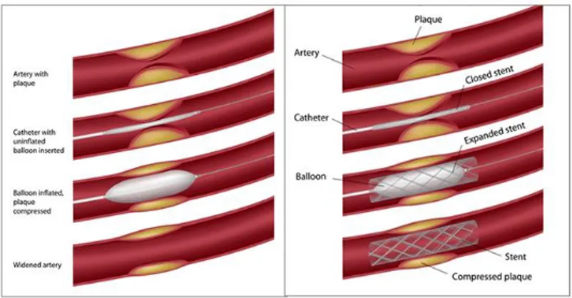Gambar 2 1 (1) Proses balon angioplasty pada pembuluh darah  arteri koroner yang mengalami penyempitan dikarenakan plak, 