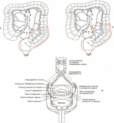 Gambar II : (E) Ligasi mesenterika inferior distal arteri  iliaka kiri (F) Ligasi cabang dari mesenterika inferior (G) Identifikasi saraf cation of presacral