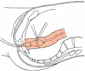 Gambar  : Single-layer anastomosis dan penyelarasan bagian posterior sebelum dilakukan 