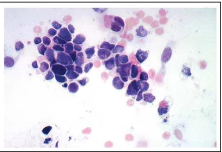 Gambar 9 .  Small cell lung carcinoma. Tampak kelompokan sel 