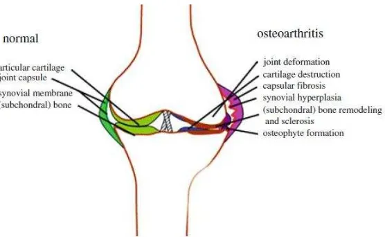 Gambar 1. Proses patologis pada osteoartritis 