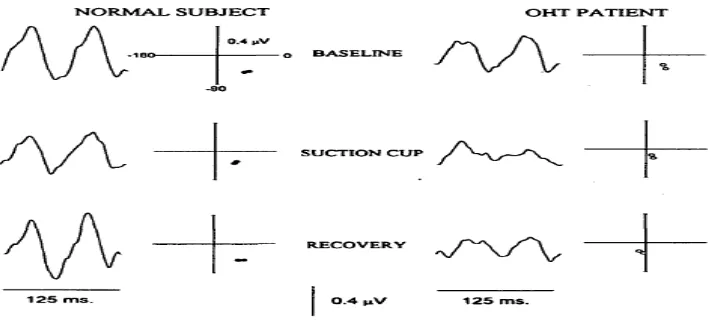 Gambar 5. Gambaran Pattern Electroretinogram. (Colotto et al, 1996). 