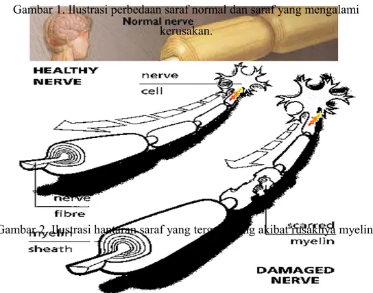 Gambar 1. Ilustrasi perbedaan saraf normal dan saraf yang mengalami kerusakan.