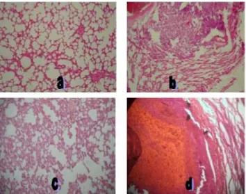 Gambar 3. Histopatologi jaringan paru dengan alveolus (a) normal, (b) penebalan,(c) proliferasi tumor dan (d) kanker.